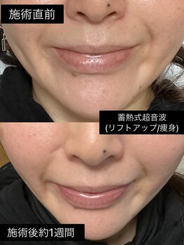 アイビークイーン(I.B.QUEEN)/直後からフェイスリフト