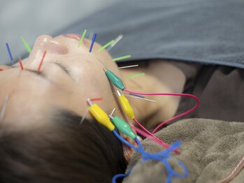 のぐち 石橋阪大前の写真/アプリ無しで写真が撮れる！フェイスラインすっきり、小顔が叶う美容鍼♪むくみ/たるみ改善/リフトUP◎