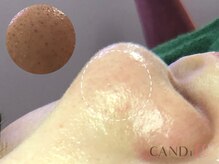 キャンディ 名古屋金山店(CANDi)/ハイドラピーリング黒ずみ毛穴◎