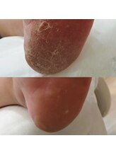 ティーネイル/足裏集中角質フットケア