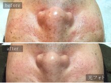 アムールサロン(Amour salon)/光フェイシャルでシミケア/新宿