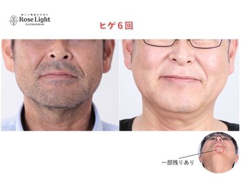 ヘルディン(heldin +555)/メンズ脱毛