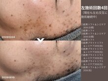 アンドアンド(&and)/盛り上がりのあるシミの集中ケア