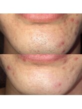 メンズ脱毛 リボーン(reborn)/脱毛効果と肌質改善