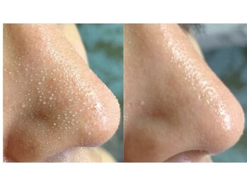 ラクーン(RACCOON)/【毛穴クリアフェイシャル】