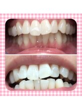 カシワビューティーココ(kashiwa beauty coco)/セルフホワイトニング