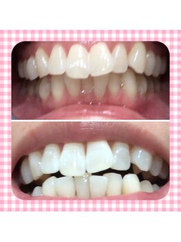 カシワビューティーココ(kashiwa beauty coco)/セルフホワイトニング