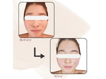 ヴィセル(VISEL)/小顔矯正&光フェイシャル