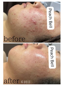 ピーチベル 美濃加茂店(PeachBell)/光フェイシャル