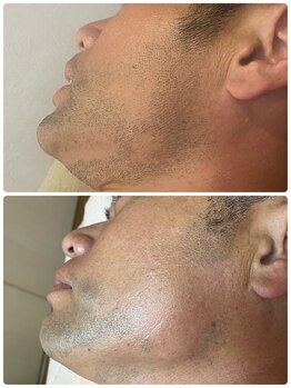 リレア(RELAIR)/【　メンズ脱毛　】