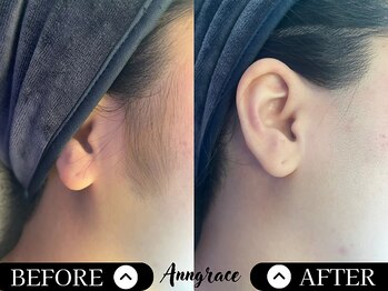 アングレイス(Anngrace)/【全身もみ上げ】Before/After