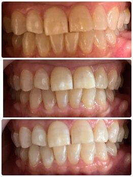 白の雫/歯科提携ホワイトニング