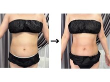 ドクターエイジレス(DR.AGELESS)/脂肪冷却コース1回