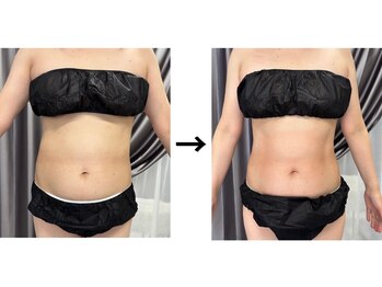 ドクターエイジレス(DR.AGELESS)/脂肪冷却コース1回