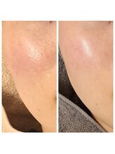 エリン(ERIN)/セラピール