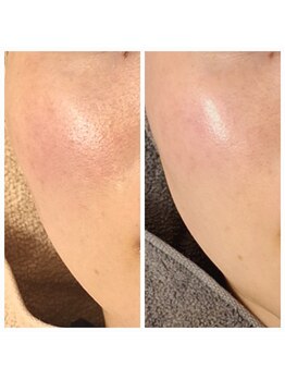 エリン(ERIN)/セラピール