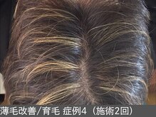 オアシスラグーン(OASIS LAGOON)/育毛促進（症例4施術2回）