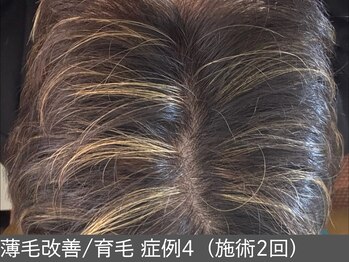 オアシスラグーン(OASIS LAGOON)/育毛促進(症例4施術2回)