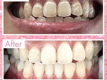 エクシアホワイトニング 姫路店/歯のビフォーアフター