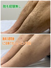 オリ(Oli)/メンズ脱毛