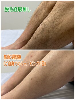 オリ(Oli)/メンズ脱毛