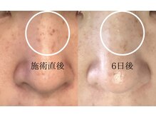 リレハウス(LileHouse)/人気NO1　最新シミケア