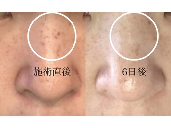 リレハウス(LileHouse)/人気NO1　最新シミケア