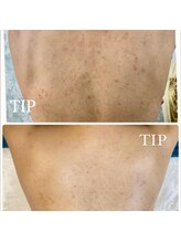 ノヴェイル(NoVeil)/Before/After