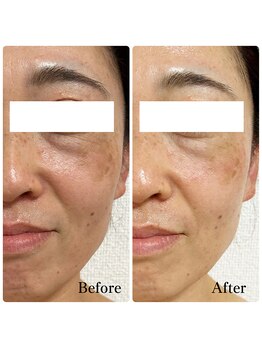 エース(ACE.)/くすみ解消☆ツヤとハリ感アップ