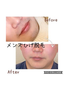 エノン(ENON)/メンズひげ脱毛！