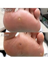 巻き爪補正店 久留米店/タコ/魚の目/角質ケア