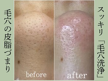 ティーツリー 名古屋 桜山(Tea Tree)/詰まりっぱなしの毛穴を