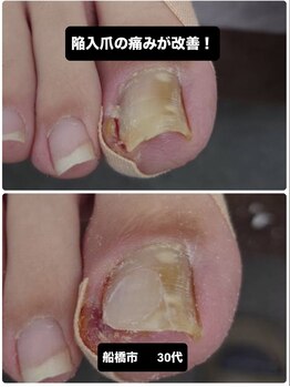 巻き爪じゅん 千葉駅前店/巻き爪陥入爪の痛みを改善する法