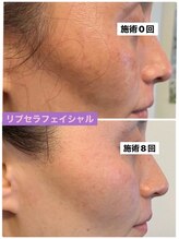 プリュネル(Prunelle)/プラズマシャワー