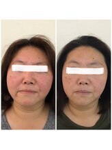 クラティス 伊那店(CRATIS)/小顔ケア