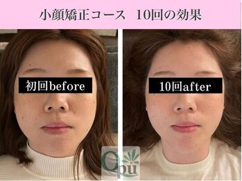 キュープ 福岡大牟田店(Qpu)/小顔矯正10回コースの変化