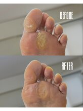 おん/厚くなった角質(タコ)