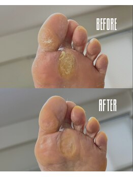 おん/厚くなった角質(タコ)