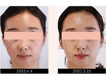 ラグラン銀座メディカルエステ 高輪ゲートウェイ店/【FACE】セルマジ・ビフォアフ