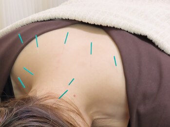 マック鍼灸院(MAC鍼灸院)/首・肩こりの方に