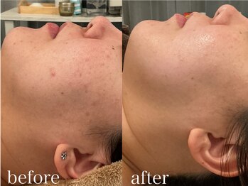 グレイティア(gratia)/肌育 バクテリウムピール