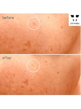 ルミラポー(Lumira Peau)/シミ集中ケア