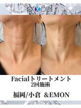 アンドエモン(&EMON)/【お顔】プロセル効果