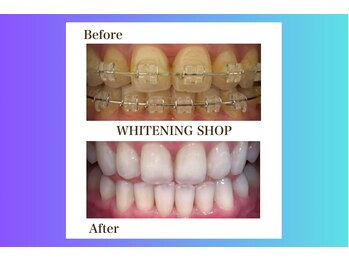 ホワイトニングショップ北四番丁店【4月中旬 NEW OPEN(予定)】/【ビフォーアフター】矯正中