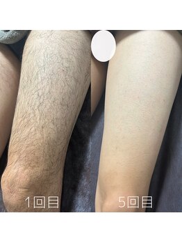 カナウ(KANAU)/脚脱毛（20代前半男性）