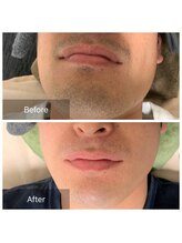 脱毛サロン メンズ 堂々/脱毛ビフォーアフター