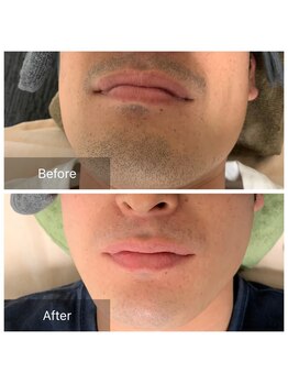 脱毛サロン メンズ 堂々/脱毛ビフォーアフター