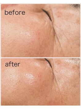 ビープラス(Biplus)/ハーブピーリング