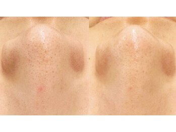 ラクーン(RACCOON)/