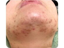 お顔そりローズマリー/ハーブピーリング